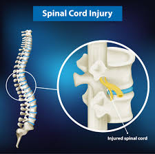 As the smallest digit, the pinky is located next to the ring finger. Diagram Showing Spinal Cord Injury 1235082 Vector Art At Vecteezy