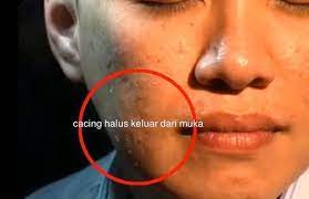 Ia menggunakan kain putih yang dinyalakan api sambil diletakkan pada keseluruhan muka secara berperingkat. Tongkrongan Ghaul Rupanya Kita Kena Kencing Ulat Resdung Keluar Daripada Muka