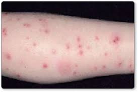 Image result for Papular urticaria