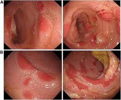 Image result for Blood in stool