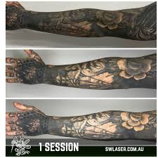 With no consumable costs, tattoo removal is a high profit procedure. 1 Session Of Laser Tattoo Removal Shows How Much Falls Out In A Space Of 3
