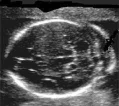 Https Flourishpaediatrics Com Au Docs Soft Ultrasound Markers Pdf