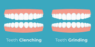 Maybe you would like to learn more about one of these? Mouth Guard For Clenching Or Grinding Teeth