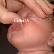 Alabama Tongue-Tie Center