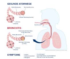 Inhalation Bei Bronchitis Und Husten Emser