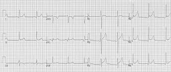 Image result for Pericarditis