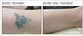 Covering belfast, newry, londonderry, ballymena, newtownabbey, coleraine, craigavon, lisburn, newtownards, magherafelt, enniskillen, bangor and others. Tattoo Removal After Care On Second Thought Northern Ireland Belfast Newtownabbey On Second Thought