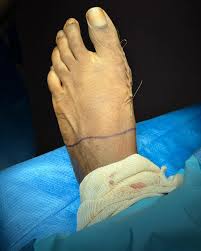 📷 Before & After: Bunion Surgery!! Our team of surgeons performed this  surgery earlier today, helping our patient