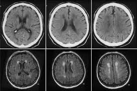 Marklagerveranderungen Bei Neurodegenerativen Und Vaskularen Demenzerkrankungen Springerlink