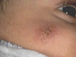 They'll inject a tiny amount of fluid called tuberculin just below the skin in. Principles Of Pediatric Dermatology Chapter7 Mycobacterial Skin Infections Tuberculosis Of The Skin