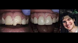 But first, consider the cost for just a single porcelain dental veneer that can run well over $500. Porcelain Veneers Before And After Dentist In Larchmont Ny