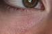 Cholesterol Bumps Under Eyes