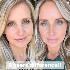 Natural Botox at home with only 2 ingredients Skin like a 30 year old, even  at 65 only polite members will say thank you for the recipe 😊 The recipe  in first comment 😊