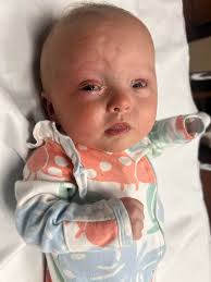 Introducing your newest G-tube graduate, Miss Reagan!! She has been doing  so amazing with her eating and weight gain, that they removed her tube this  morning 🥹 We do have extra supplies,