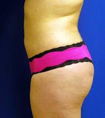 We did not find results for: Brazilian Butt Lift Before And After 01 Dr Kotis