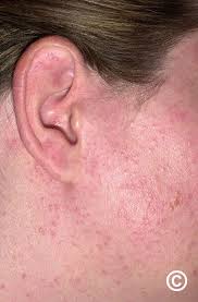 Image result for Photodermatitis