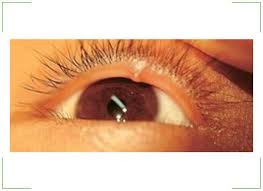 как лечить ячмень на нижнем веке в домашних условиях Https Xn 80aadc3bb0afph1dp3h Xn P1ai Zrenie Kak Ubrat S Glaznogo Yabloka Prozrachnyj Puzyrek Html