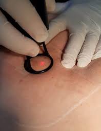 Spitalizare de.laser ecoghidated endovenous ablation is a modern, extremely efficient and minimally invasive method in the treatment of lower limb. Procto Vein Clinic Tratamente Cu Laser Varice Si Hemoroizi