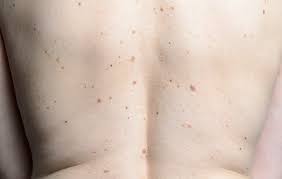 When thinking about beauty spots, marilyn monroe's famous cheek mark. Why Did This Woman Suddenly Develop Thousands Of Moles All Over Her Body Women S Health