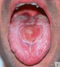 La enfermedad se puede presentar con la aparición de un solo chancro (se muestra aquí en un pene) o muchos. Manifestaciones Cutaneas Atipicas En La Sifilis Sciencedirect