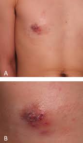 Image result for zoster under breasts