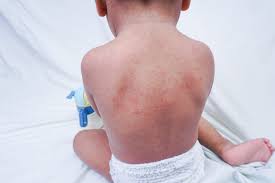 Image result for sweat rash on back baby