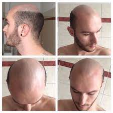 Norfolkbuzz Needs To Work The Mpb Look More Like The Mpb Fringe And Beard Balding Bald Men Shaving