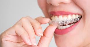 Every 2 weeks you need to wear a new aligner set. The Invisalign 101 Everything You Need To Know