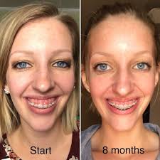 Https Mybraces4vme Wordpress Com Tag Gummy Smile Teeth Braces Dental Teeth Dentistry