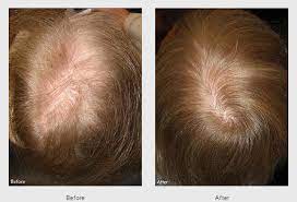 Are You One Of The 70 Of Men Who Is Suffering From Male Pattern Baldness Mpb Do You Want To Stop It And Ev Hair Loss Women Hair Loss Cure Hair