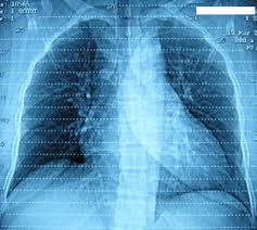 Shrinking Lung Syndrome In Systemic Lupus Erythematosus Patients With Dyspnea Sciencedirect
