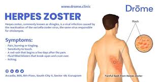 Image result for herpes zoster