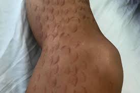 It is not unreasonable to expect that the professional carrying out the treatment will carry out the necessary duty of care towards you as their client. B C Woman Suing After Laser Hair Removal Leaves Her With Severe Burns Scarring Victoria News