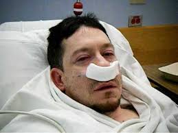 Your surgeon views the inside of your nose through a nasal endoscope which has a camera and light. Nasal Polyps Surgery Waking Up Youtube