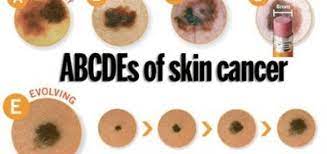 Signs and symptoms of melanoma skin cancer unusual moles, sores, lumps, blemishes, markings, or changes in the way an area of the skin looks or feels may be a sign of melanoma or another type of skin cancer, or a warning that it might occur. Skin Cancer Signs Symptoms And Causes Science Online