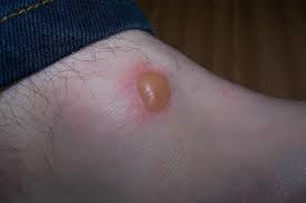 Briefly touching a hot pot, for example, would give you a first first degree burns are the least severe kind of burns. First Degree Burns Vs Second Degree Burns Difference And Comparison Diffen