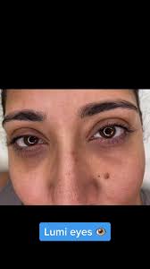 This was her first treatment of Lumi eyes and can see a big difference, she  planning to have one more treatment. With Lumi eyes I’ll advice 2-3 session  #lumieyes #darkcircles #undereyebags ...