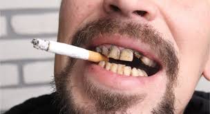 Also, stay in tune with your mouth—look at your teeth closely in a mirror on a regular basis. How To Remove Stains From Teeth Caused By Smoking With Dental Procedures