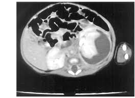 Image result for Perinephric Abscess