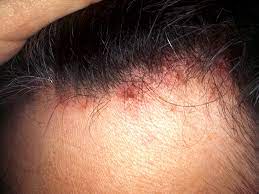 Ingrown pubic hair cyst can really be disturbing and annoying at the same time. Scalp Folliculitis Symptoms Pictures Causes Shampoos And Creams