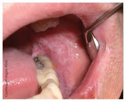 Image result for lichen planus on tongue)