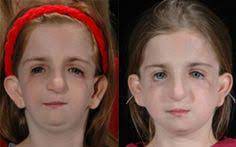 A rare reticulate pigmentary disorder abstract. 42 Francis Ideas In 2021 Collins Syndrome Rare Disorders