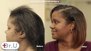 A surgical specialist is a physician who has additional training in a specific area of surgery. Patient Results Women S Hair Transplants In Los Angeles By Dr Ugraft
