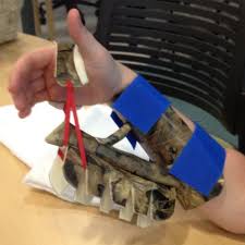 Dinosaur Splint Dynamic Wrist Flexion I Have Never Made On Eof These But I Ccould Have Interesting Use Of Cammo Splin Hand Therapy Wrist Support Orthosis