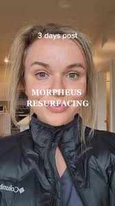 How Long After Morpheus 8 Can I Get A Hydrafaci