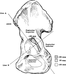 We did not find results for: Quadrant System For Safe Placement Of Acetabular Screws From Download Scientific Diagram