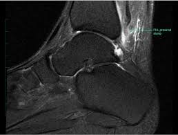 The flexor digiti minimi brevis (flexor brevis minimi digiti, flexor digiti quinti brevis) lies under the metatarsal bone on the little toe, and resembles one of the interossei. Fhl Tendonitis Injuries Foot Ankle Orthobullets