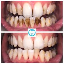And one of the biggest myths is that brushing your teeth right after drinking coffee will help prevent 4 ways to avoid coffee stained teeth. How To Get Rid Of Teeth Staining L London Hygienist