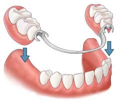 The main qualifier for having dental implants is having enough bone. Partial Dentures A Viable Alternative To Dental Implants