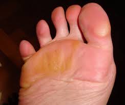 Hola tengo un callo en la parte de abajo del dedo gordo del pie, molesta demasiado para caminar. Como Evitar Durezas Y Callos En Los Pies